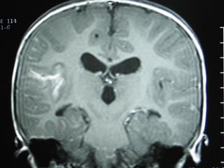 Diagnóstico de TB pulmonar
TBC latente: PPD (+). Rx Tórax normal
TBC activa: PPD (+). Rx Tórax anormal o
                     clínica otra localización


Diagnóstico Rx: Rx Tórax A-P y lateral: 10% PPD (+)
            CT Tórax: No justificado habitualmente


Broncoscopia fibro-óptica puede ser útil en algunos
casos de TB: establece compromiso bronquial, grado
obstrucción, y necesidad de corticoides.
 