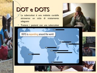 DOT e DOTS
                           La tubercolosi è una malattia curabile
                            attraverso un ciclo di trattamento
                            adeguato
                           Trattare i pazienti con una tubercolosi
                            attiva (presenza di bacilli tubercolari
                            nell’escreato) che possono trasmettere
                            la malattia ad altri, è il metodo più
                            efficace per ridurre la diffusione della TB
                           DOTS         (Directly    Observed
                            Treatment Short course) è la
                            strategia   raccomandata   a   livello
                            internazionale per il controllo della
                            tubercolosi
                           È una strategia efficace e a basso costo




G Orlando – Unità MTS
Osp L Sacco - Milano
 