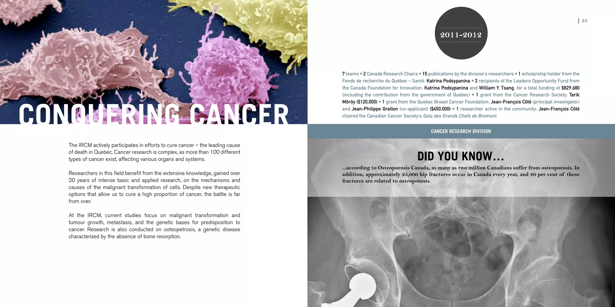 32 | 2011-2012 IRCM ANNUAL REPORT                                                                                                                                                                                   | 33

                                                                                                                                                  2011-2012



                                                                                                    7 teams • 2 Canada Research Chairs • 15 publications by the division’s researchers • 1 scholarship holder from the
                                                                                                    Fonds de recherche du Québec – Santé: Katrina Podsypanina • 2 recipients of the Leaders Opportunity Fund from
                                                                                                    the Canada Foundation for Innovation: Katrina Podsypanina and William Y. Tsang, for a total funding ot $829,680
                                                                                                    (including the contribution from the government of Quebec) • 1 grant from the Cancer Research Society: Tarik




CONQUERING CANCER
                                                                                                    Möröy ($120,000) • 1 grant from the Quebec Breast Cancer Foundation: Jean-François Côté (principal investigator)
                                                                                                    and Jean-Philippe Gratton (co-applicant) ($450,000) • 1 researcher active in the community: Jean-François Côté
                                                                                                    chaired the Canadian Cancer Society’s Gala des Grands Chefs de Bromont


                                                                                                                                              Cancer research division

                     The IRCM actively participates in efforts to cure cancer – the leading cause

                                                                                                                                        DID YOU KNOW…
                     of death in Quebec. Cancer research is complex, as more than 100 different
                     types of cancer exist, affecting various organs and systems.
                                                                                                    ...according to Osteoporosis Canada, as many as two million Canadians suffer from osteoporosis. In
                     Researchers in this field benefit from the extensive knowledge, gained over    addition, approximately 25,000 hip fractures occur in Canada every year, and 80 per cent of these
                     20 years of intense basic and applied research, on the mechanisms and          fractures are related to osteoporosis.
                     causes of the malignant transformation of cells. Despite new therapeutic
                     options that allow us to cure a high proportion of cancer, the battle is far
                     from over.

                     At the IRCM, current studies focus on malignant transformation and
                     tumour growth, metastasis, and the genetic bases for predisposition to
                     cancer. Research is also conducted on osteopetrosis, a genetic disease
                     characterized by the absence of bone resorption.
 