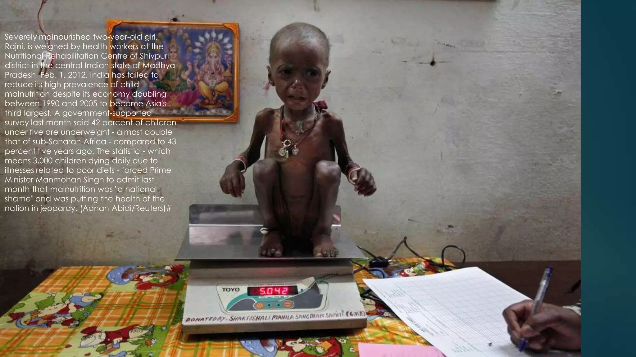 19
Severely malnourished two-year-old girl,
Rajni, is weighed by health workers at the
Nutritional Rehabilitation Centre of Shivpuri
district in the central Indian state of Madhya
Pradesh, Feb. 1, 2012. India has failed to
reduce its high prevalence of child
malnutrition despite its economy doubling
between 1990 and 2005 to become Asia's
third largest. A government-supported
survey last month said 42 percent of children
under five are underweight - almost double
that of sub-Saharan Africa - compared to 43
percent five years ago. The statistic - which
means 3,000 children dying daily due to
illnesses related to poor diets - forced Prime
Minister Manmohan Singh to admit last
month that malnutrition was "a national
shame" and was putting the health of the
nation in jeopardy. (Adnan Abidi/Reuters)#
 