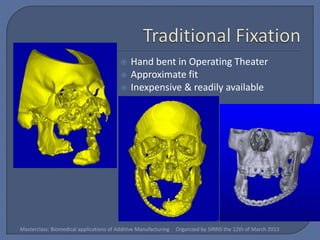    Hand bent in Operating Theater
                                            Approximate fit
                                            Inexpensive & readily available




Masterclass: Biomedical applications of Additive Manufacturing   Organized by SIRRIS the 12th of March 2013
 