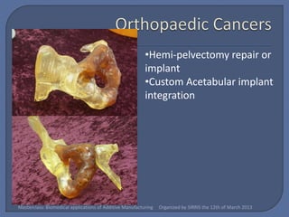 •Hemi-pelvectomy repair or
                                                          implant
                                                          •Custom Acetabular implant
                                                          integration




Masterclass: Biomedical applications of Additive Manufacturing   Organized by SIRRIS the 12th of March 2013
 