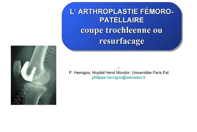 2013 039 Prothese Femoro Patellaire Coupe Trochleenne Ou Resurfaca