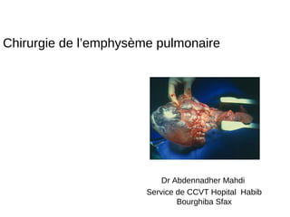 Chirurgie de l’emphysème pulmonaire
Dr Abdennadher Mahdi
Service de CCVT Hopital Habib
Bourghiba Sfax
 