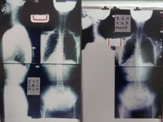 2013 09-28 玉玲-脊椎與健康