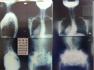 2013 09-28 玉玲-脊椎與健康