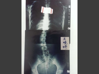 2013 09-28 玉玲-脊椎與健康