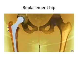 Replacement hip
 