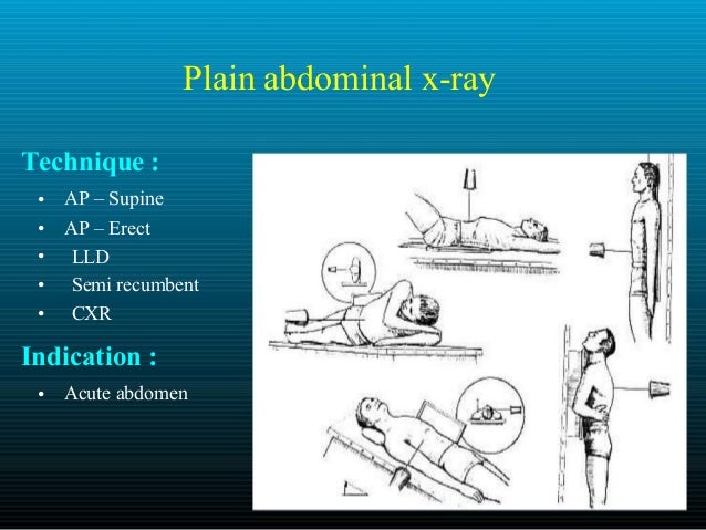 imaging of gi system diagram of cecal volvulus 