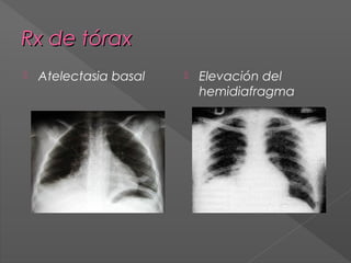 Rx de tórax


Atelectasia basal



Elevación del
hemidiafragma

 