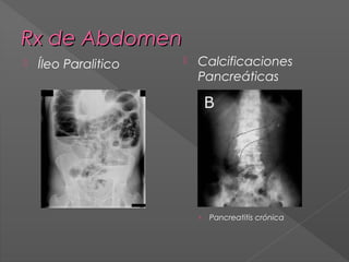 Rx de Abdomen


Íleo Paralitico



Calcificaciones
Pancreáticas

›

Pancreatitis crónica

 