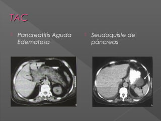 TAC


Pancreatitis Aguda
Edematosa



Seudoquiste de
páncreas

 