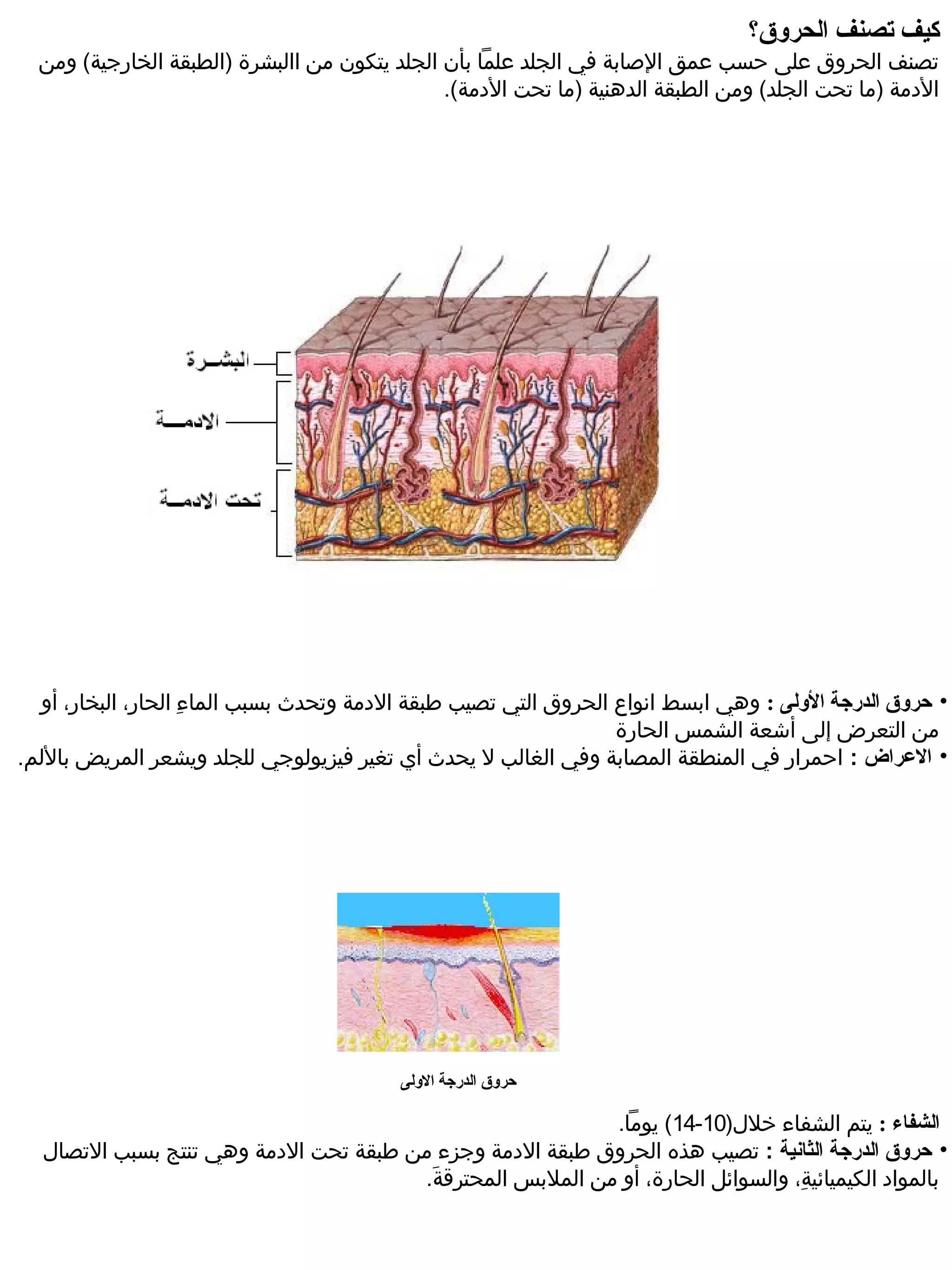‫كيف تصنف الحرلوق؟‬
  ‫تصنف الحروق على حسب عمق الصابة في الجلد علما بأن الجلد يتكون من االبشرة )الطبقة الخارجية( ومن‬
                                               ‫الدمة )ما تحت الجلد( ومن الطبقة الدهنية )ما تحت الدمة(.‬




  ‫• حرلوق الدررجة اللولى : وهي ابسط انواع الحروق التي تصيب طبقة الدمة وتحدث بسبب الماء الحار، البخار، أو‬
              ‫،ِ‬    ‫،ِ‬
                                                                 ‫من التعرض إلى أشعة الشمس الحارة‬
‫• الرعراض : احمرار في المنطقة المصابة وفي الغالب ل يحدث أي تغير فيزيولوجي للجلد ويشعر المريض باللم.‬




                                          ‫حرلوق الدررجة اللولى‬

                                                          ‫الشفاء : يتم الشفاء خلل)01-41( يوما.‬
  ‫• حروق الدرجة الثانية : تصيب هذه الحروق طبقة الدمة وجزء من طبقة تحت الدمة وهي تنتج بسبب التصال‬
                                       ‫بالمواد الكيميائية، والسوائل الحارة، أو من الملبس المحترقة.‬
                                        ‫.َ‬                                      ‫،ِ‬
 