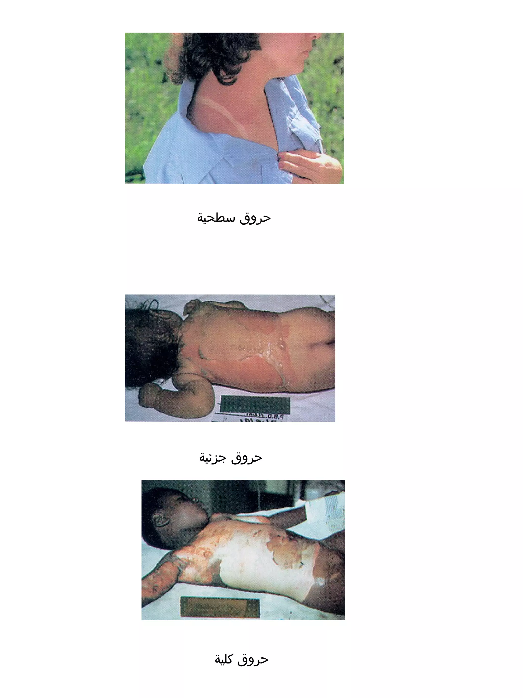 ‫حروق سطحية‬




‫حروق جزئية‬




  ‫حروق كلية‬
 
