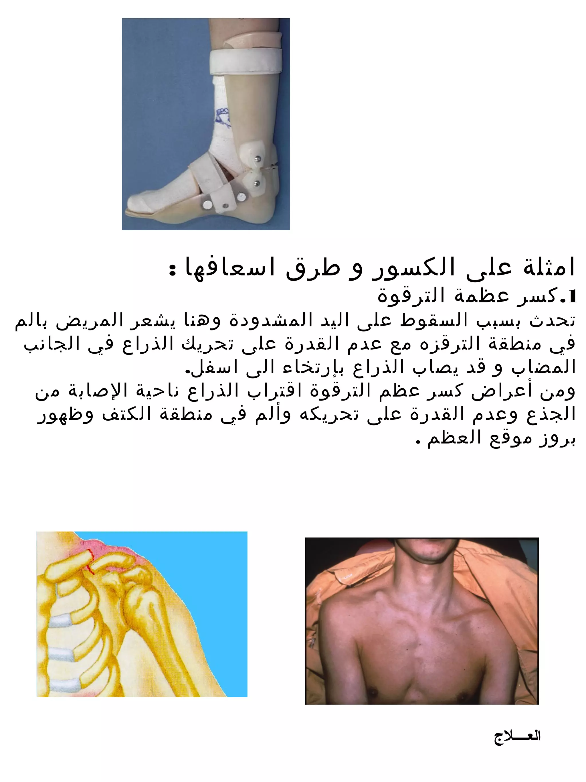 ‫امثلة على الكسور و طرق اسعافها :‬
                                       ‫1. كسر عظمة الترقوة‬
‫تحدث بسبب السقوط على اليد المشدودة وهنا يشعر المريض بالم‬
 ‫في منطقة الترقزه مع عدم القدرة على تحريك الذراع في الجانب‬
                   ‫المضاب و قد يصاب الذراع بإرتخاء الى اسفل.‬
  ‫وم ن أعراض كسر عظم الترقوة اقتراب الذراع ناحية الصابة م ن‬
   ‫الجذع وعدم القدرة على تحريكه وألم في منطقة الكتف وظهور‬
                                            ‫بروز موقع العظم .‬




                                                    ‫العــــل ج‬
 