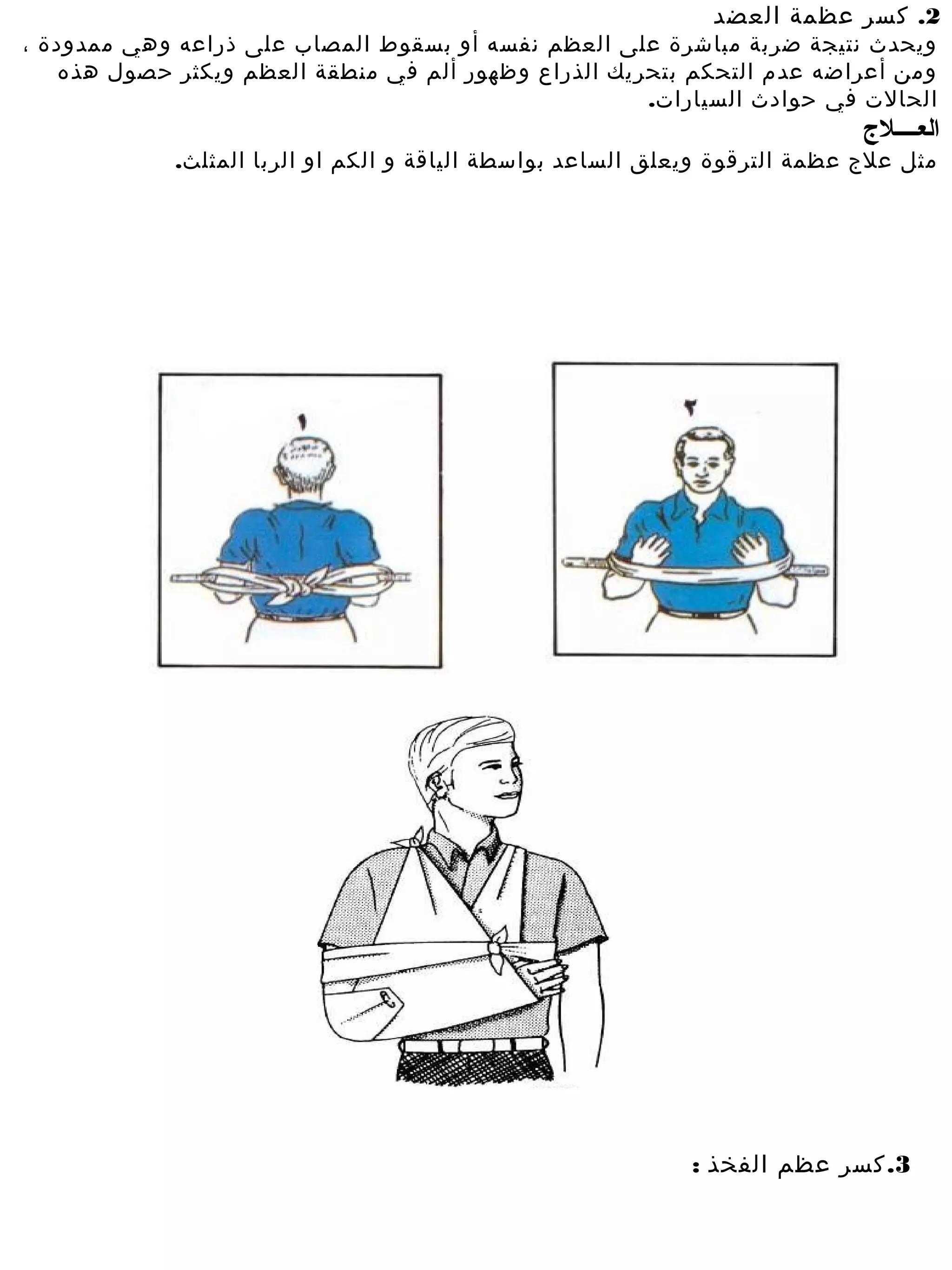 ‫2. كسر عظمة العضد‬
‫ويحدث نتيجة ضربة مباشرة على العظم نفسه أو بسقوط المصاب على ذراعه وهي ممدودة ،‬
   ‫وم ن أعراضه عدم التحكم بتحريك الذراع وظهور ألم في منطقة العظم ويكثر حصول هذه‬
                                                     ‫الحالت في حوادث السيارات.‬
                                                                             ‫العــــل ج‬
             ‫مثل علج عظمة الترقوة ويعلق الساعد بواسطة الياقة و الكم او الربا المثلث.‬




                                                             ‫3. كسر عظم الفخذ :‬
 
