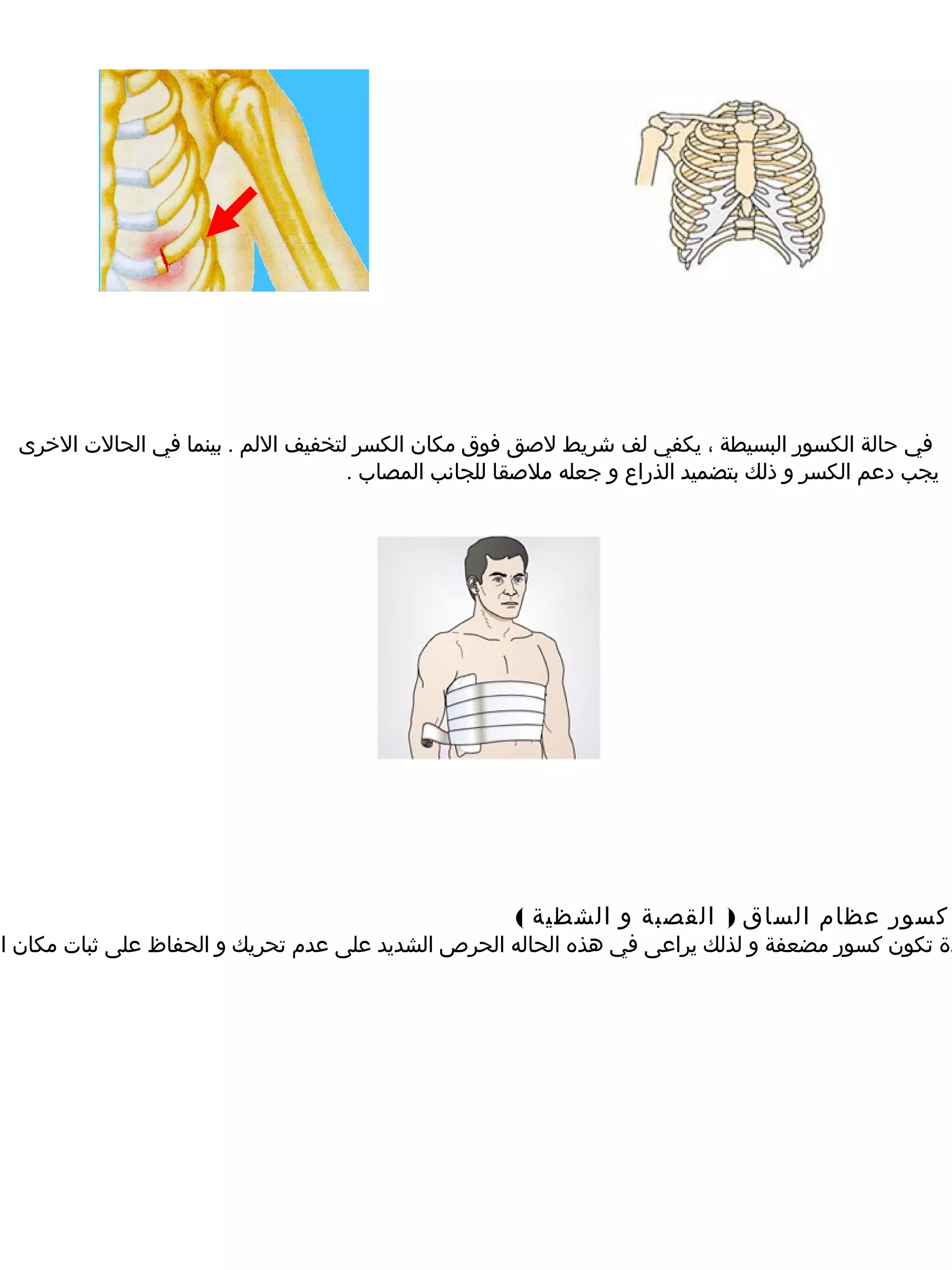 ‫في حالة الكسور البسيطة ، يكفي لف شريط لصق فوق مكان الكسر لتخفيف اللم . بينما في الحالت الخرى‬
                                      ‫يجب دعم الكسر و ذلك بتضميد الذراع و جعله ملصقا للجانب المصاب .‬




                                                       ‫كسور عظام الساق ) القصبة و الشظية (‬
‫دة تكون كسور مضعفة و لذلك يراعى في هذه الحاله الحرص الشديد على عدم تحريك و الحفاظ على ثبات مكان ال‬
 