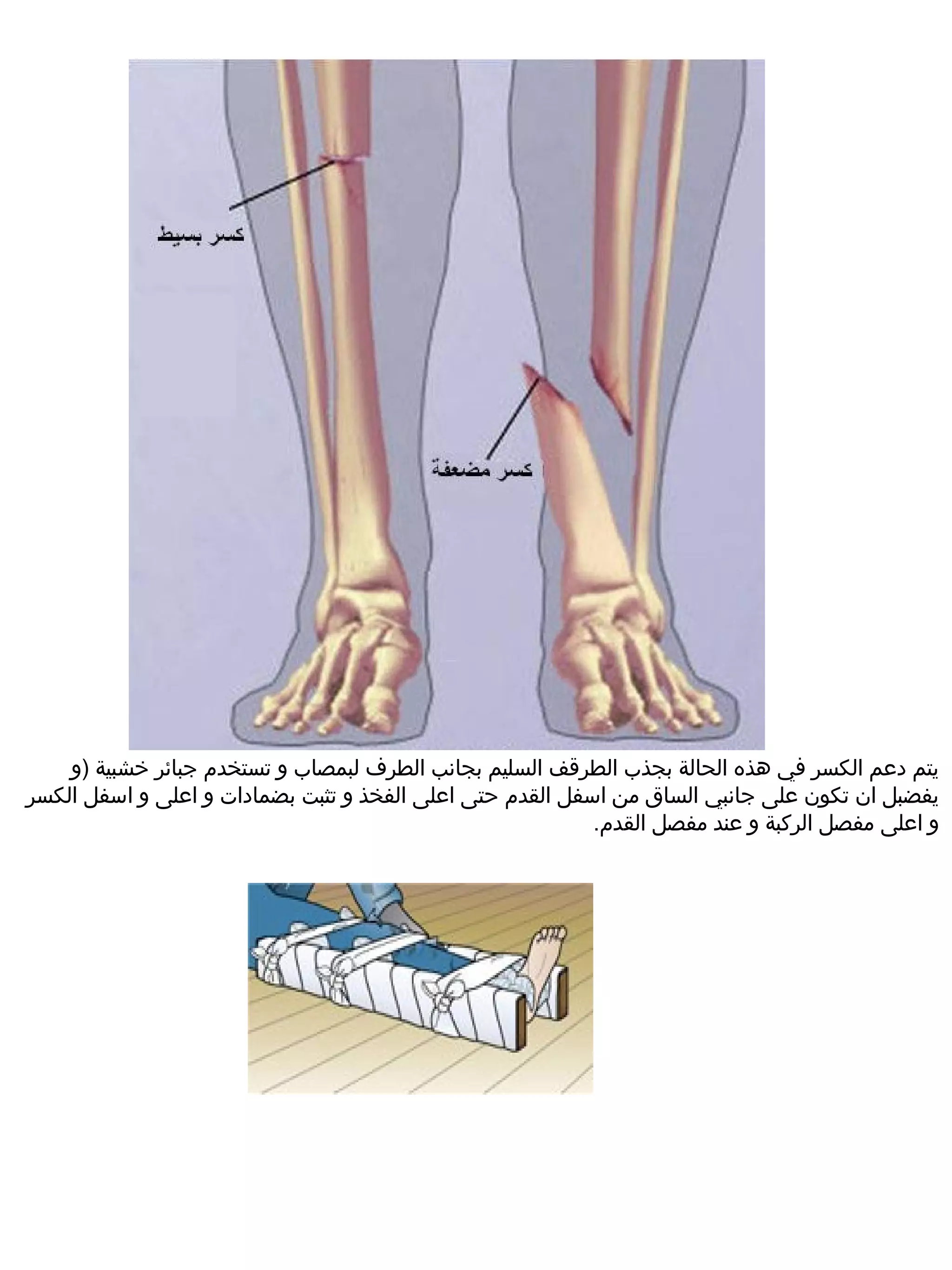 ‫يتم دعم الكسر في هذه الحالة بجذب الطرقف السليم بجانب الطر ف لبمصاب و تستخدم جبائر خشبية )و‬
‫يفضبل ان تكون على جانبي الساق م ن اسفل القدم حتى اعلى الفخذ و تثبت بضمادات و اعلى و اسفل الكسر‬
                                                           ‫و اعلى مفصل الركبة و عند مفصل القدم.‬
 