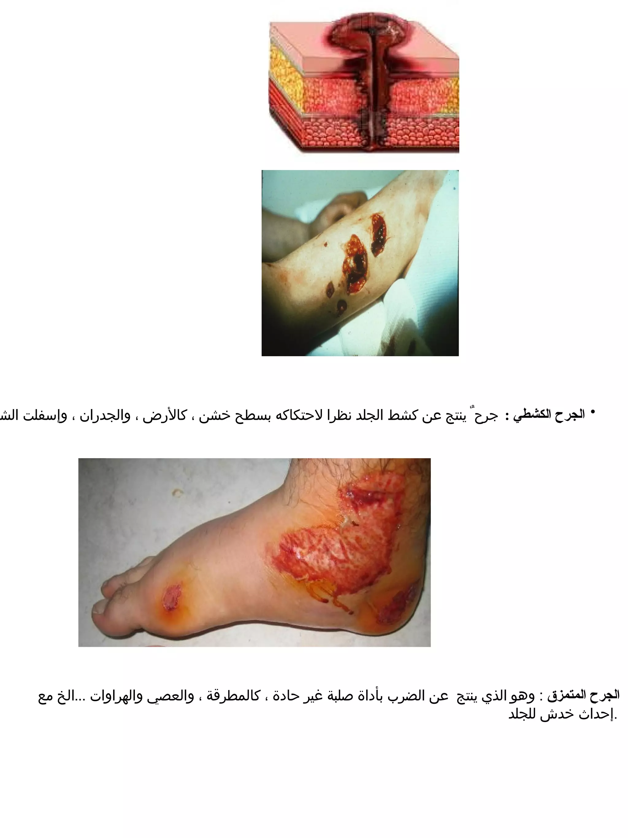 ‫• الجرح الكشطي : جرح  ٌ ينتج عن كشط الجلد نظرا لحتكاكه بسطح خشن ، كالرض ، والجدران ، وإسفلت الش‬




      ‫الجرح المتمزق : وهو الذي ينتج عن الضرب بأداة صلبة غير حادة ، كالمطرقة ، والعصي والهراوات ...الخ مع‬
                                                                                    ‫.إحداث خدش للجلد‬
 