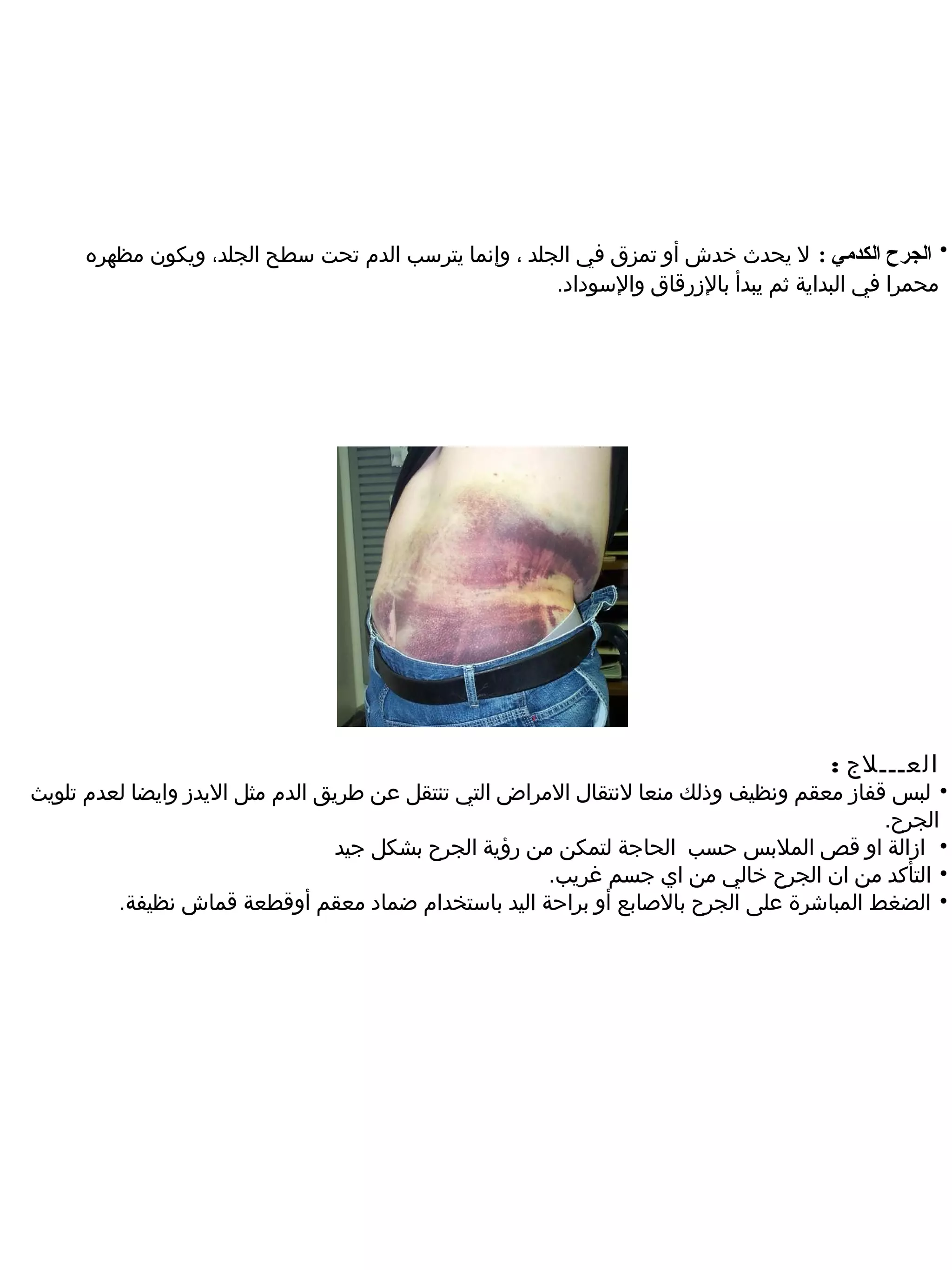 ‫• الجرح الكدمي : ل يحدث خدش أو تمزق في الجلد ، وإنما يترسب الدم تحت سطح الجلد، ويكون مظهره‬
                                                      ‫محمرا في البداية ثم يبدأ بالرزرقاق والسوداد.‬




                                                                                     ‫العـــلج :‬
‫• لبس قفارز معقم ونظيف وذلك منعا لنتقال المراض التي تنتقل عن طريق الدم مثل اليدرز وايضا لعدم تلويث‬
                                                                                            ‫الجرح.‬
                                  ‫• ارزالة او قص الملبس حسب الحاجة لتمكن من رؤية الجرح بشكل جيد‬
                                                        ‫• التأكد من ان الجرح خالي من اي جسم غريب.‬
         ‫• الضغط المباشرة على الجرح بالصابع أو براحة اليد باستخدام ضماد معقم أوقطعة قماش نظيفة.‬
 