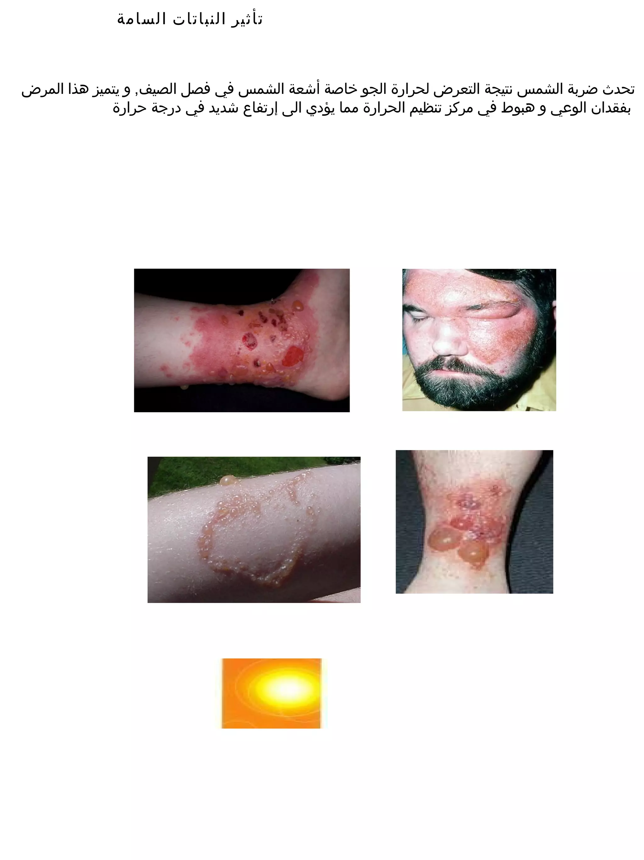 ‫تأثير النباتات السامة‬



‫تحدث ضربة الشمس نتيجة التعرض لحرارة الجو خاصة أشعة الشمس في فصل الصيف, و يتميز هذا المرض‬
             ‫بفقدان الوعي و هبوط في مركز تنظيم الحرارة مما يؤدي الى إرتفاع شديد في درجة حرارة‬
 