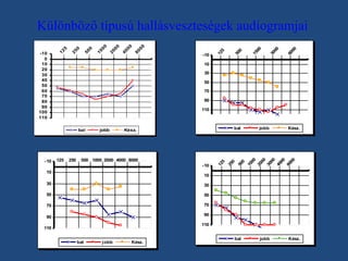 60
00

30
00

15
00

50
0

12
5

00
80

00
40

00

00

20

-10
10
30
50
70
90
110

500 1000 2000 4000 8000
-10

10

jobb

Kész.

50
0
10
00
20
00
30
00
40
00
80
00

250

bal

Kész.

25
0

125

jobb

12
5

bal

-10

10

0
50

0
25

-10
0
10
20
30
40
50
60
70
80
90
100
110

12

5

Különböző típusú hallásveszteségek audiogramjai

10

30

30

50

50

70

70
90

90

110

110
bal

j obb

Kész.

bal

jobb

Kész.

 