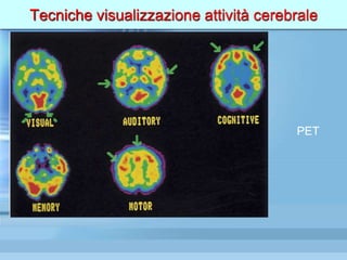 Tecniche visualizzazione attività cerebrale
PET
 