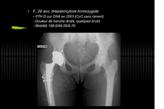 2013 032. Douleur sur PTH céramique-céramique