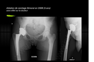2013 032. Douleur sur PTH céramique-céramique
