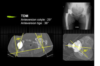 2013 032. Douleur sur PTH céramique-céramique