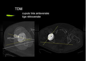 2013 032. Douleur sur PTH céramique-céramique