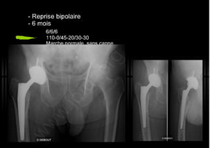 2013 032. Douleur sur PTH céramique-céramique