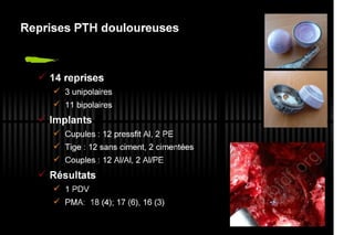 2013 032. Douleur sur PTH céramique-céramique