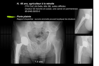 2013 032. Douleur sur PTH céramique-céramique
