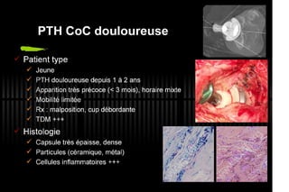 2013 032. Douleur sur PTH céramique-céramique