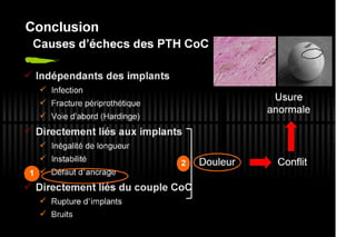 2013 032. Douleur sur PTH céramique-céramique