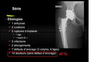 2013 032. Douleur sur PTH céramique-céramique
