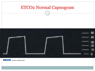 ETCO2 Normal Capnogram
13

Source undetermined

 