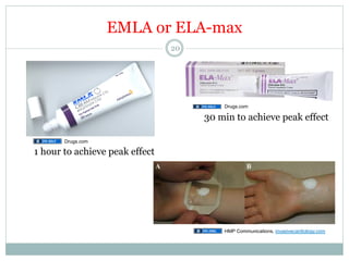 EMLA or ELA-max
20

Drugs.com

30 min to achieve peak effect
Drugs.com

1 hour to achieve peak effect

HMP Communications, invasivecardiology.com

 