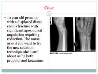 Case
41

—  10 year old presents

with a displaced distal
radius fracture with
significant apex dorsal
angulation requiring
reduction. The nurse
asks if you want to try
the new sedation
technique she heard
about using both
propofol and ketamine.

Source undetermined

 