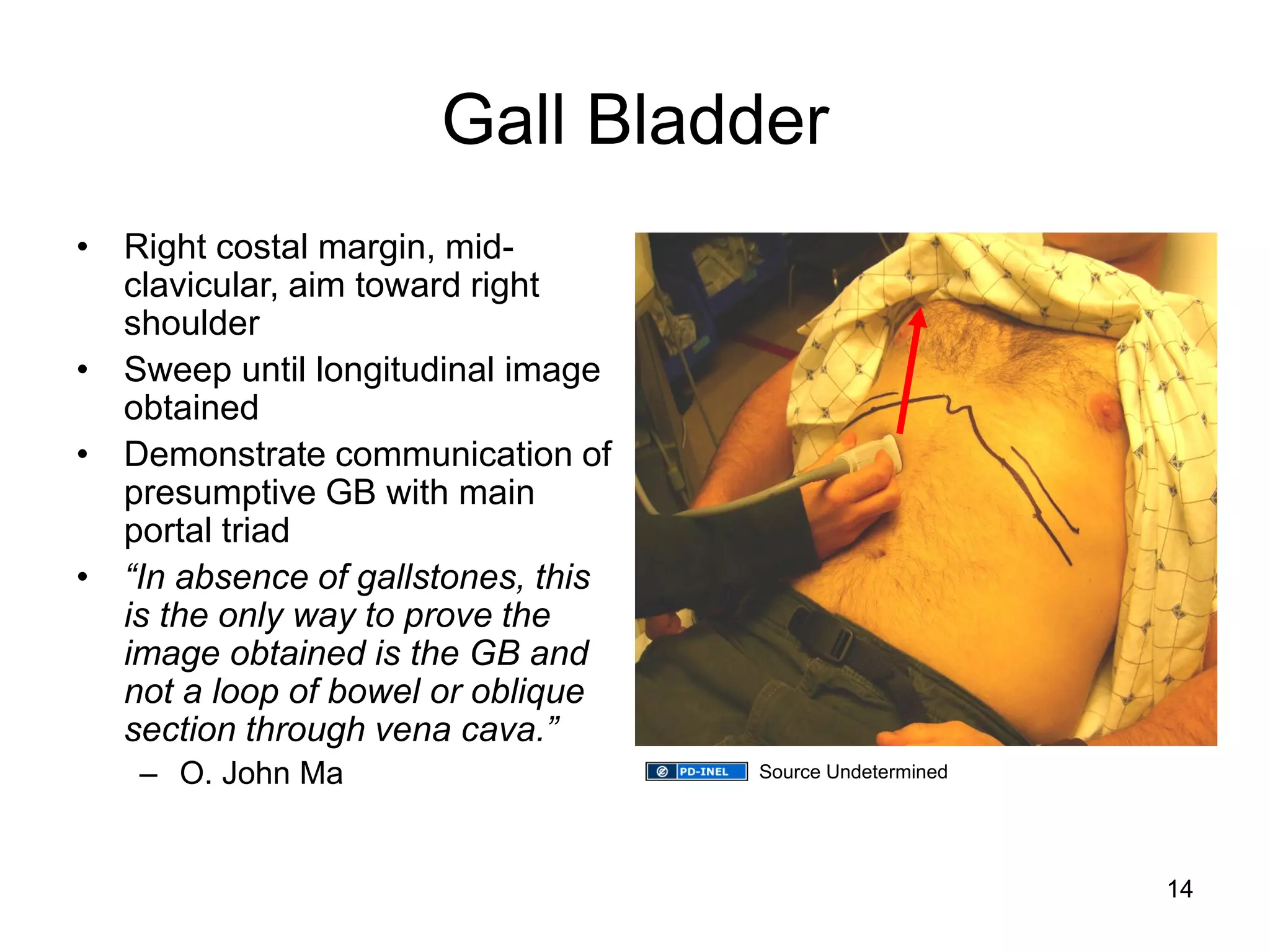 Gall Bladder 
•Right costal margin, mid- clavicular, aim toward right shoulder 
•Sweep until longitudinal image obtained 
•Demonstrate communication of presumptive GB with main portal triad 
•“In absence of gallstones, this is the only way to prove the image obtained is the GB and not a loop of bowel or oblique section through vena cava.” 
–O. John Ma 
14 
Source Undetermined  