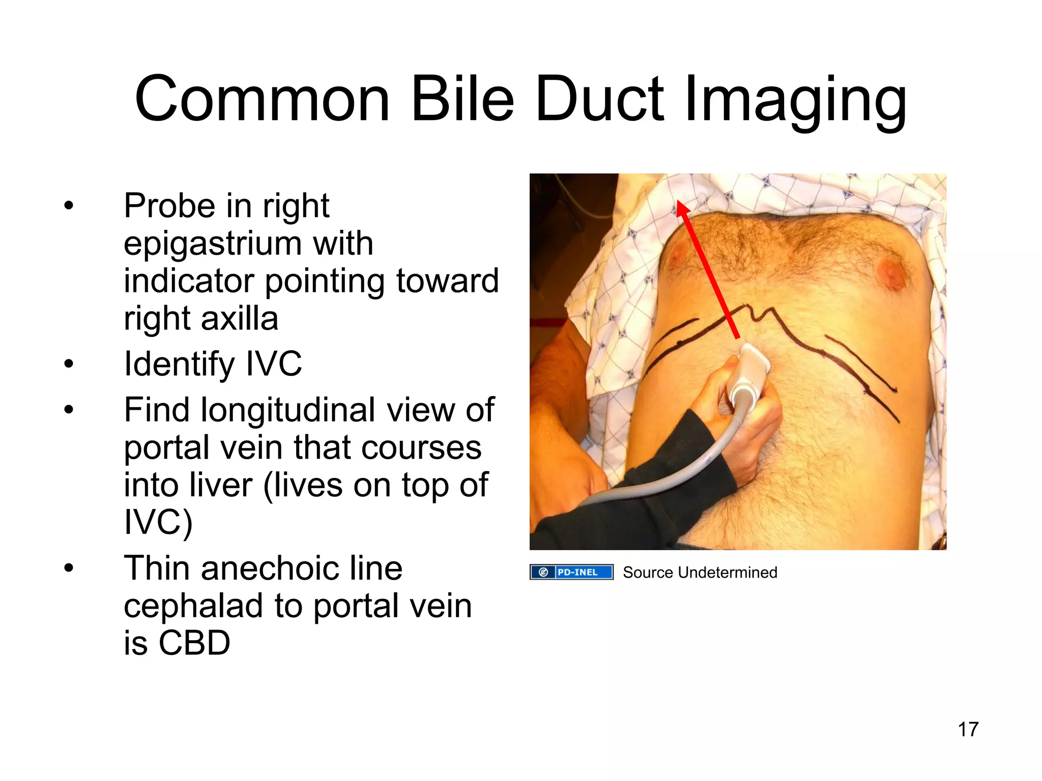 Common Bile Duct Imaging 
•Probe in right epigastrium with indicator pointing toward right axilla 
•Identify IVC 
•Find longitudinal view of portal vein that courses into liver (lives on top of IVC) 
•Thin anechoic line cephalad to portal vein is CBD 
17 
Source Undetermined  