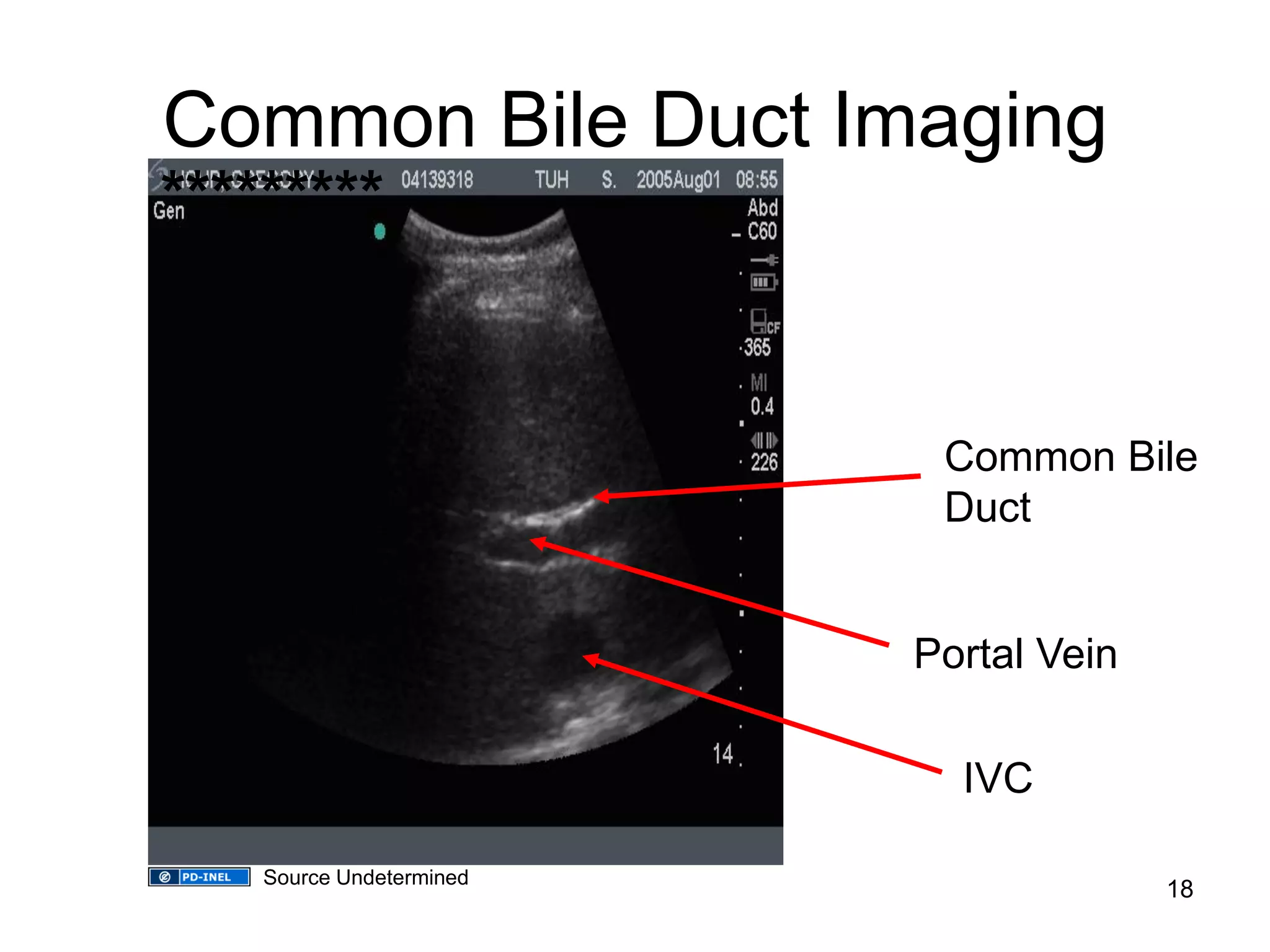 Common Bile Duct Imaging 
********* 
IVC 
Portal Vein 
Common Bile Duct 
18 
Source Undetermined  