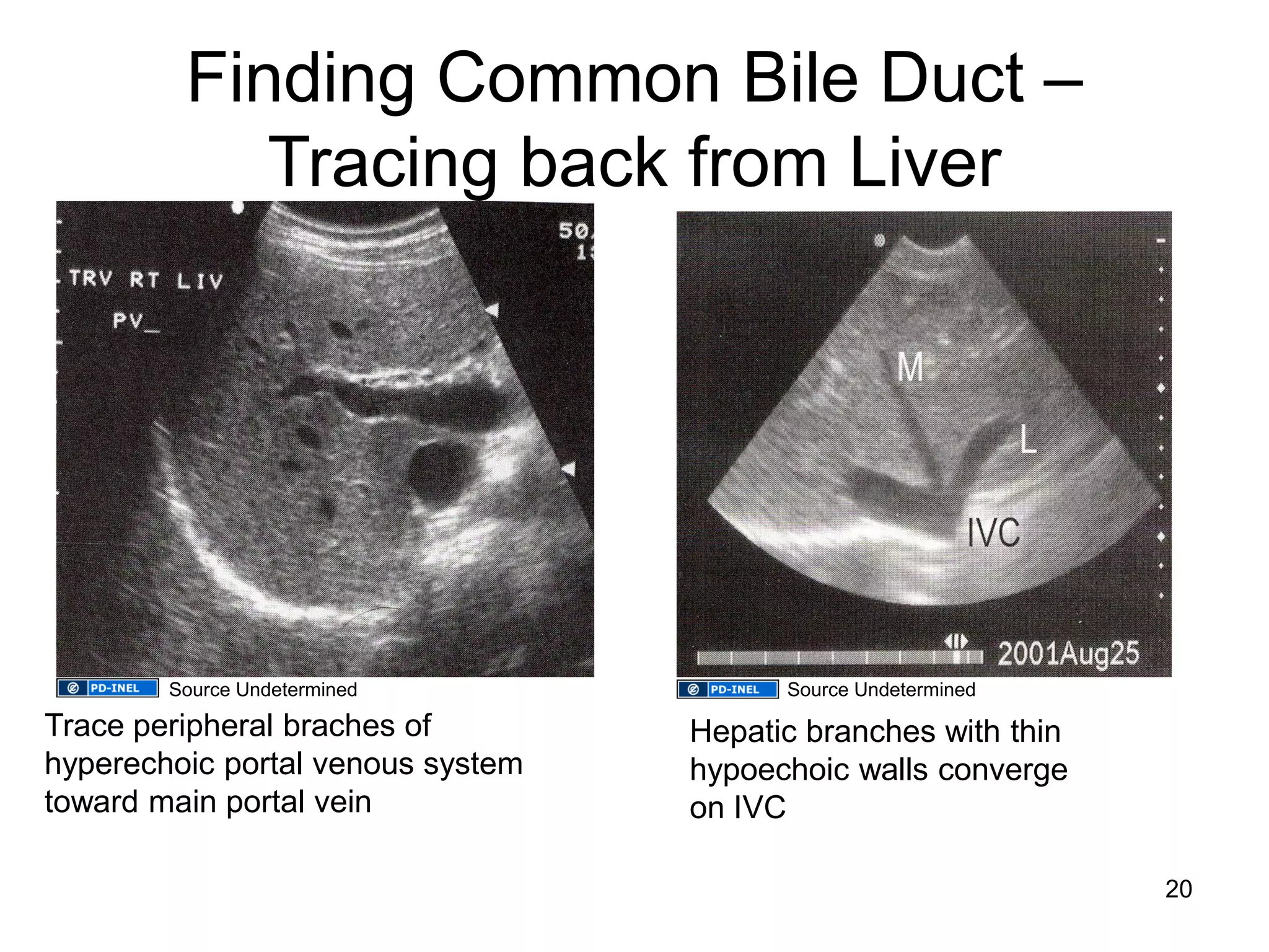 Finding Common Bile Duct – Tracing back from Liver 
Hepatic branches with thin 
hypoechoic walls converge 
on IVC 
Trace peripheral braches of hyperechoic portal venous system toward main portal vein 
20 
Source Undetermined 
Source Undetermined  