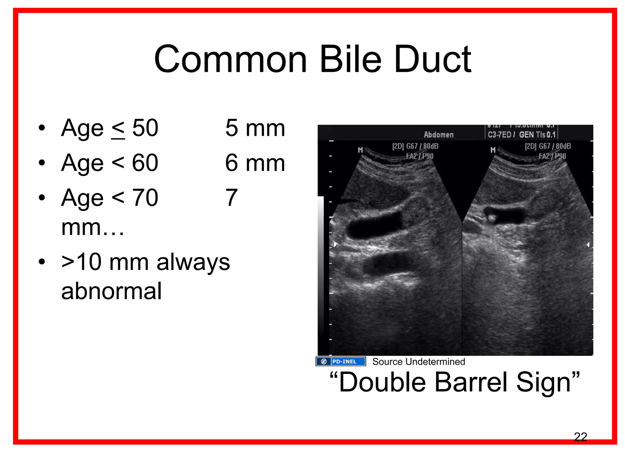 Common Bile Duct 
• Age < 50 5 mm 
• Age < 60 6 mm 
• Age < 70 7 
mm… 
• >10 mm always 
abnormal 
“Double Barrel Sign” 
22 
Source Undetermined 
 