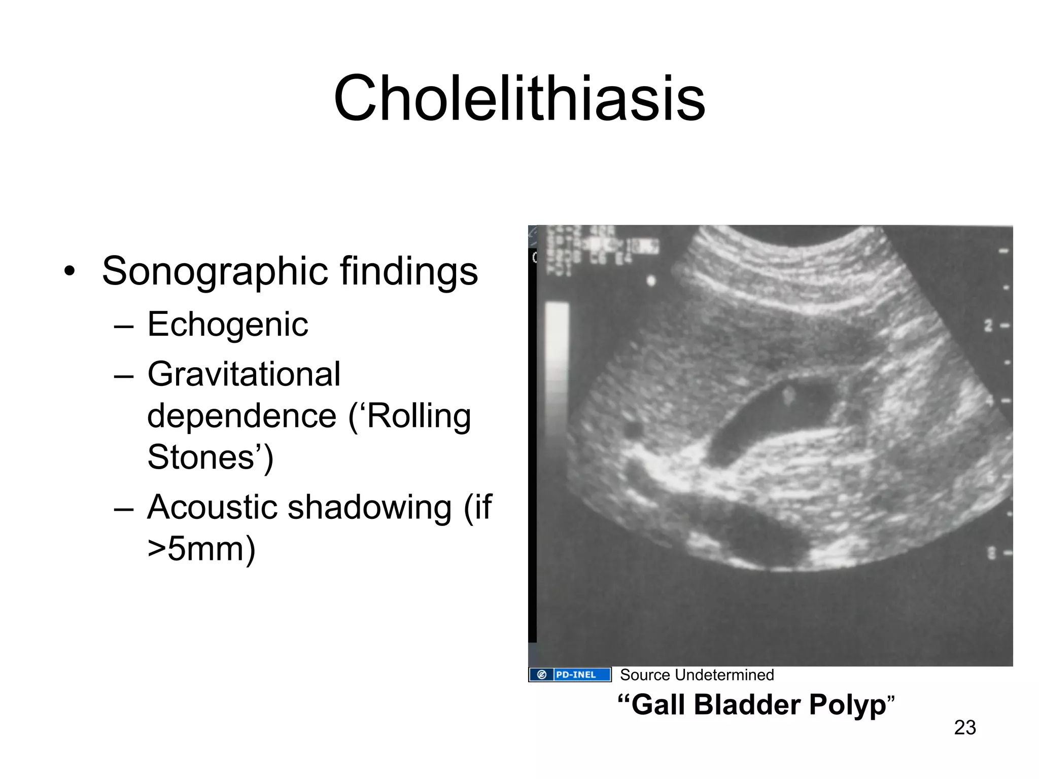 Cholelithiasis 
•Sonographic findings 
–Echogenic 
–Gravitational dependence (‘Rolling Stones’) 
–Acoustic shadowing (if >5mm) 
************ 
“Gall Bladder Polyp” 
23 
Source Undetermined  