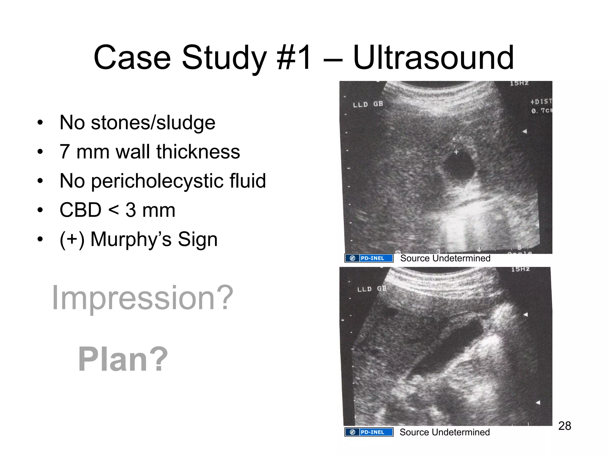 Case Study #1 – Ultrasound 
•No stones/sludge 
•7 mm wall thickness 
•No pericholecystic fluid 
•CBD < 3 mm 
•(+) Murphy’s Sign 
Impression? 
Plan? 
28 
Source Undetermined 
Source Undetermined  