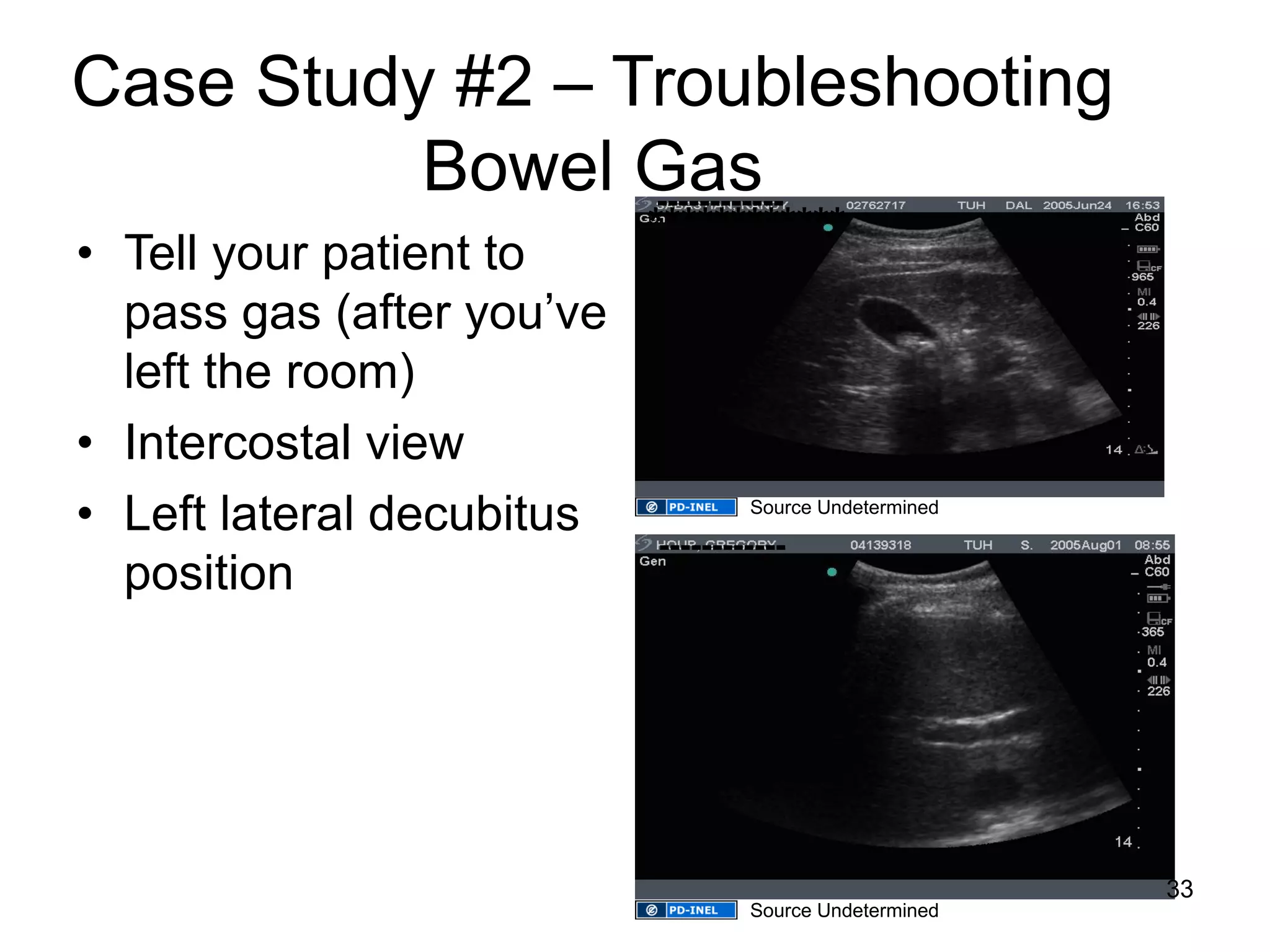Case Study #2 – Troubleshooting Bowel Gas 
•Tell your patient to pass gas (after you’ve left the room) 
•Intercostal view 
•Left lateral decubitus position 
************ 
------------ 
------------ 
33 
Source Undetermined 
Source Undetermined  