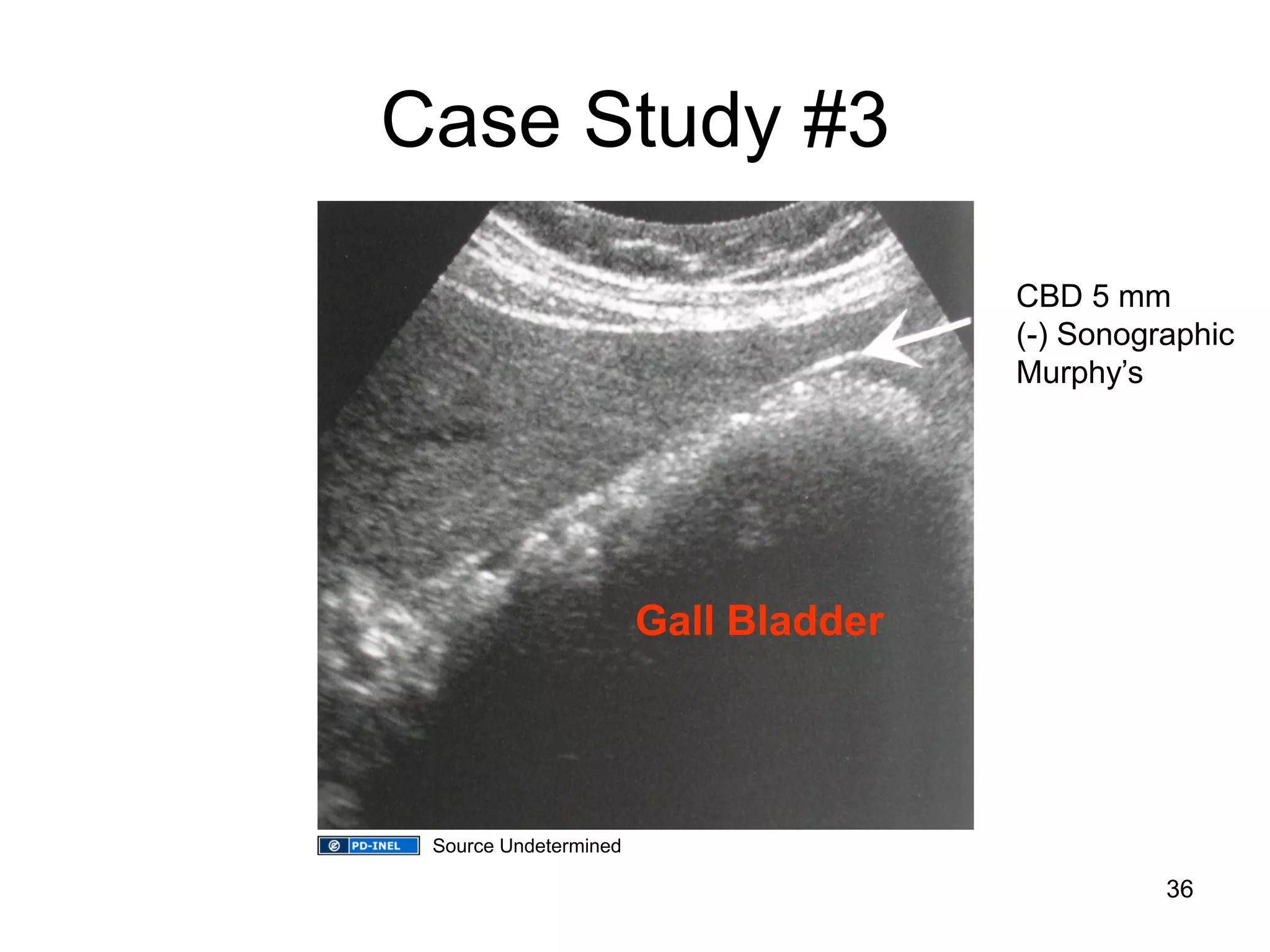 Case Study #3 
Gall Bladder 
CBD 5 mm (-) Sonographic Murphy’s 
36 
Source Undetermined  