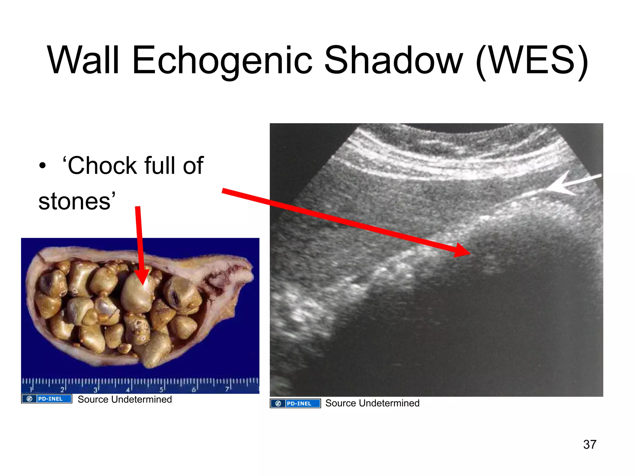 Wall Echogenic Shadow (WES) 
•‘Chock full of 
stones’ 
37 
Source Undetermined 
Source Undetermined  